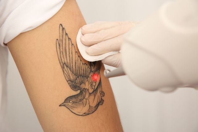 Mucho más que estética: cómo borrar tatuajes, y el ranking de los arrepentidos