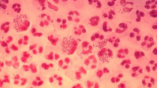 Advierten del peligro de la supergonorrea y la pérdida de eficacia de los antibióticos