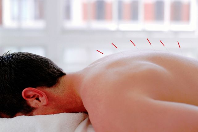 Acupuntura: todo lo que debes saber sobre esta terapia oriental
