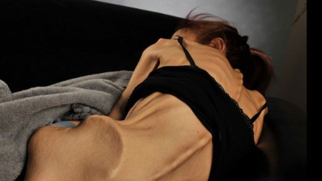 Polémica por un juez que autorizó a una mujer con anorexia a morir de hambre