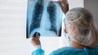 Alerta por tuberculosis en Argentina: los casos aumentaron 80% en cinco años