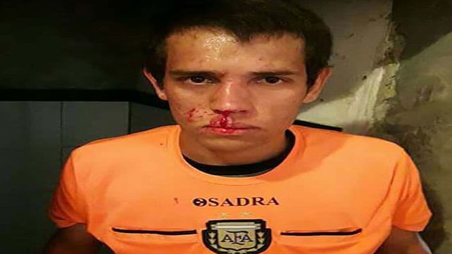 La cara del juez principal tras la agresión en el partido entre Victoria y Salto Grande.