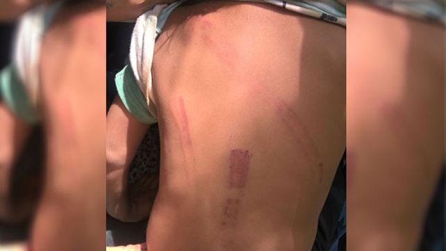 Las marcas en la espalda de la pequeña niña