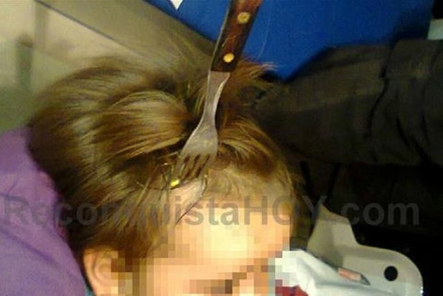 La bebé a la que le clavaron un tenedor en la cabeza fue operada y esperan por su evolución