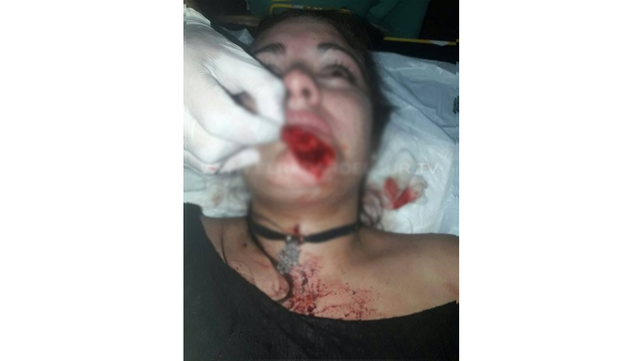 Se cruzó con su ex en un boliche y la desfiguró a mordiscones