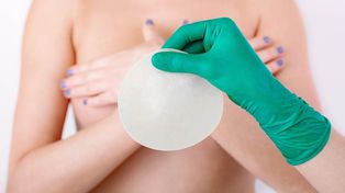 Más natural: ¿crece en Rosario la tendencia a sacarse los implantes de mamas?