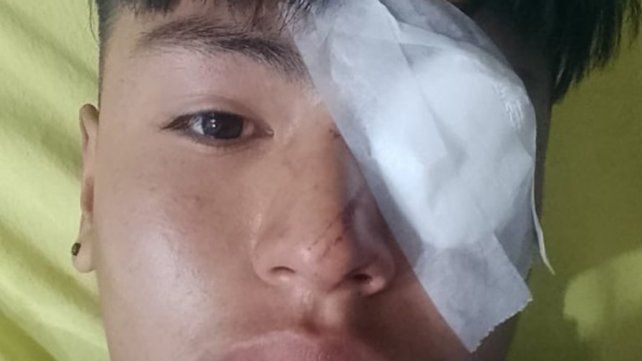 Un joven de 17 años perdió un ojo como consecuencia de la represión desatada en Jujuy el sábado