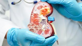 Trasplante renal: más bienestar para el paciente y el donante