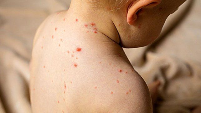 Hay alerta sanitaria en la localidad santafesina de Casilda por un caso positivo de Sarampión en Entre Ríos&nbsp;