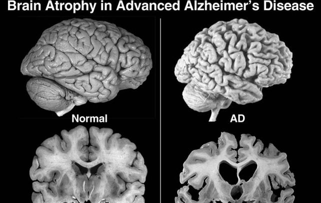 Terrible mal. Las dos fotos muestran lo mismo: la atrofia que sufre el cerebro con la progresión del Alzheimer.