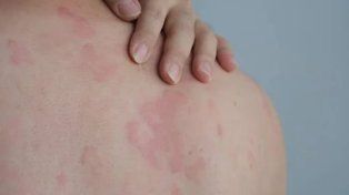 Lanzan campaña nacional gratuita para detectar la psoriasis