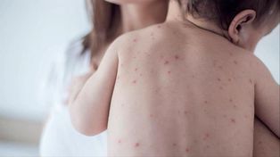 Brotes de sarampión: sostienen que los grupos antivacunas se fortalecieron y encontraron mayor visibilidad