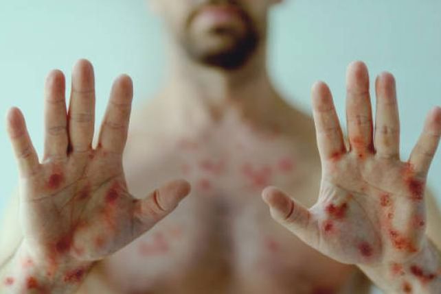 Hay más casos de viruela símica (o del mono) en varones pero también pueden contagiarse las mujeres&nbsp;