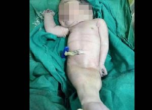 Bebé sirena sorprendió a la comunidad médica