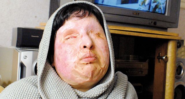 Una iran&iacute; desfigurada con &aacute;cido pidi&oacute; y obtuvo la aplicaci&oacute;n del ojo por ojo