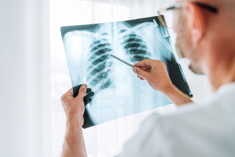 La Capital | Nódulo pulmonar: lo que tiene el Papa es un hallazgo frecuente en Santa Fe