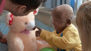 Qué es Ictiosis Arlequín, el padecimiento del niño nepalí que se convierte en piedra