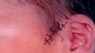 Médicos tajearon la cabeza de un bebé durante una cesárea en Salta