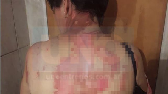 Fuerte denuncia en Gualeguaychú: Una mujer fue golpeada y quemada salvajemente por sus hijos