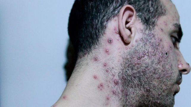 La OMS declaró la emergencia sanitaria internacional por el brote de viruela del mono
