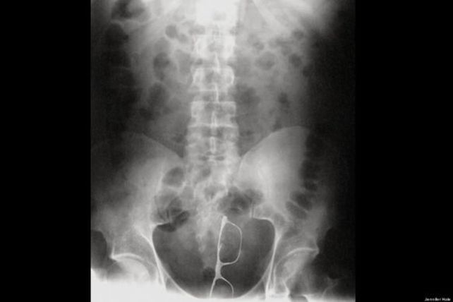 Atorados, las 100 radiografías más insólitas