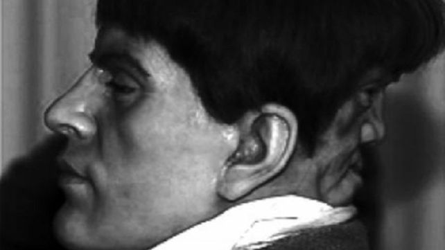 La extraña historia de Edward Mordrake, el hombre de dos caras