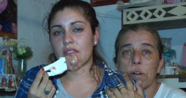Se cruzó con su ex en un boliche y la desfiguró a mordiscones