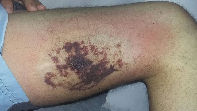 Alertan sobre picaduras de las arañas rinconeras en la provincia