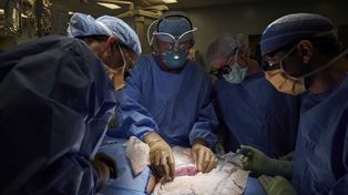 Trasplantaron con éxito un riñón de cerdo a una mujer que tenía muerte cerebral