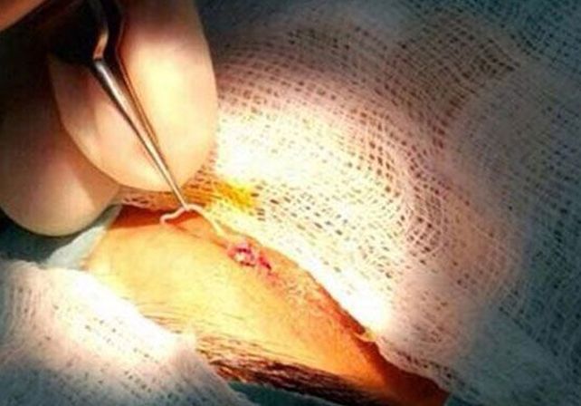 Extraen un gusano de 12 cm del ojo de una mujer