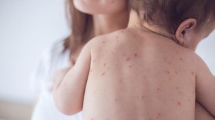 Alerta por dos casos de sarampión autóctonos