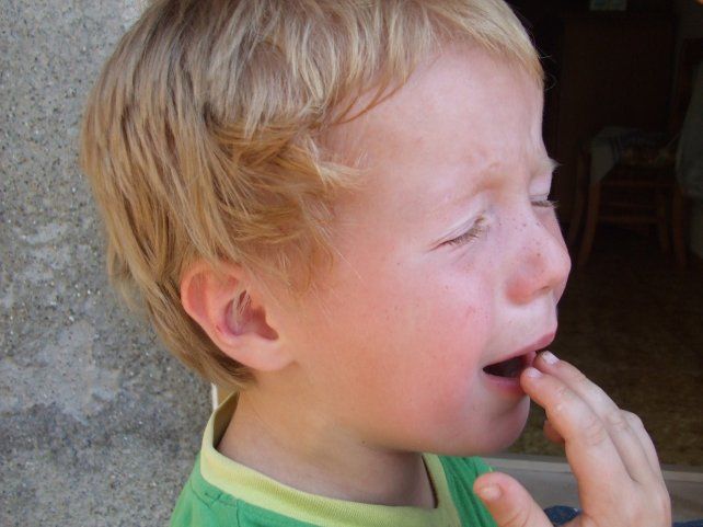 Quemaduras en niños: lo que hay que saber