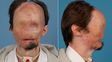 Tras un nuevo transplante, el hombre sin rostro tiene una cara nueva
