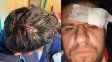El calvario de un periodista uruguayo en el 15 de Abril: Por milímetros no perdí el ojo