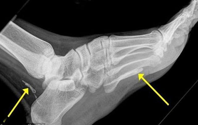 Mediante una radiografía