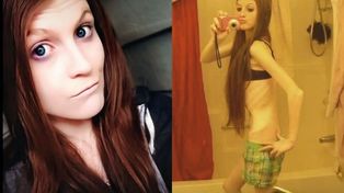 Dos hermanas compitieron para ver quien adelgazaba más rápido y ahora luchan por su vida