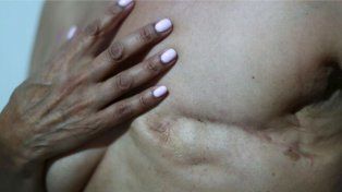 Tatuarán y reconstruirán las areolas mamarias de las personas que padecieron cáncer de mama
