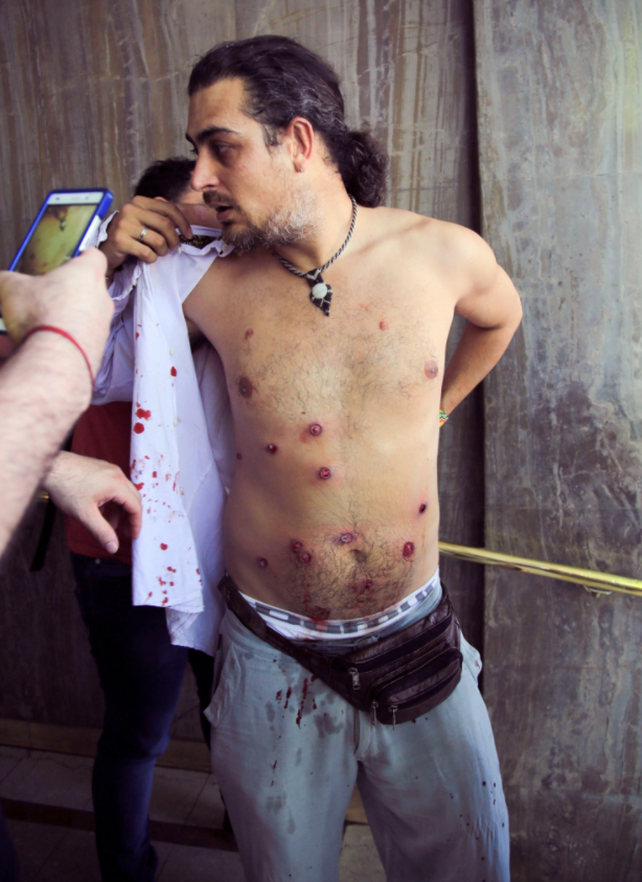 Quién es el fotógrafo que recibió diez impactos de balas de goma