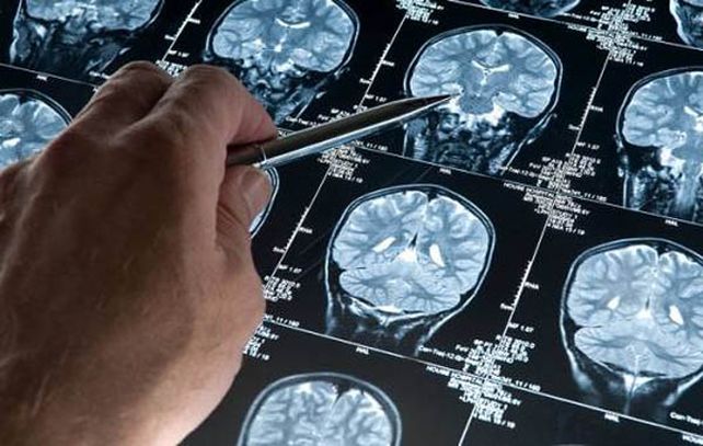 La investigación anuncia la posibilidad de desarrollar estrategias de tratamient en una etapa anterior a la enfermedad.