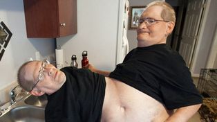 Dos gemelos siameses llevan 62 años unidos por la cintura