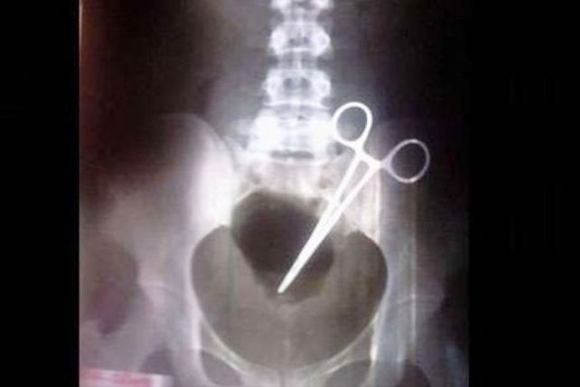 Una mujer vive con una tijera en el abdomen hace 9 meses