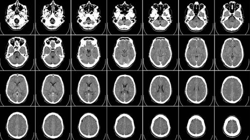 Alzheimer: Identificaron perfiles característicos de la progresión de esta enfermedad