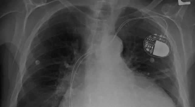 Implantes
