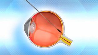 Una compañía israelí creó una retina biónica que restituye la vista a ciegos