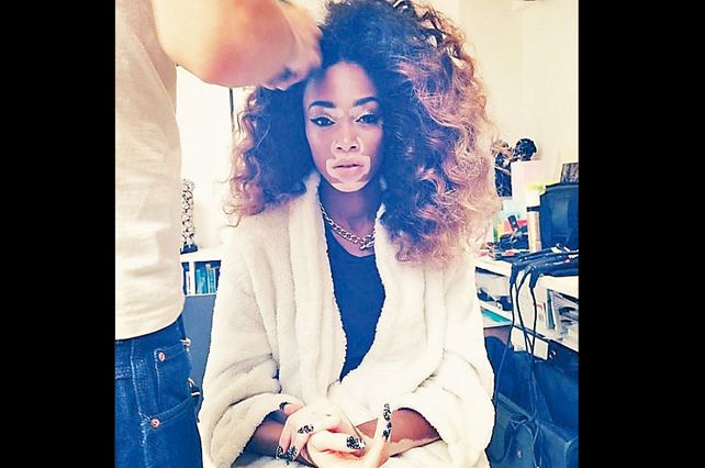 Cómo vivir con vitiligo