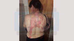 Fuerte denuncia en Gualeguaychú: Una mujer fue golpeada y quemada salvajemente por sus hijos