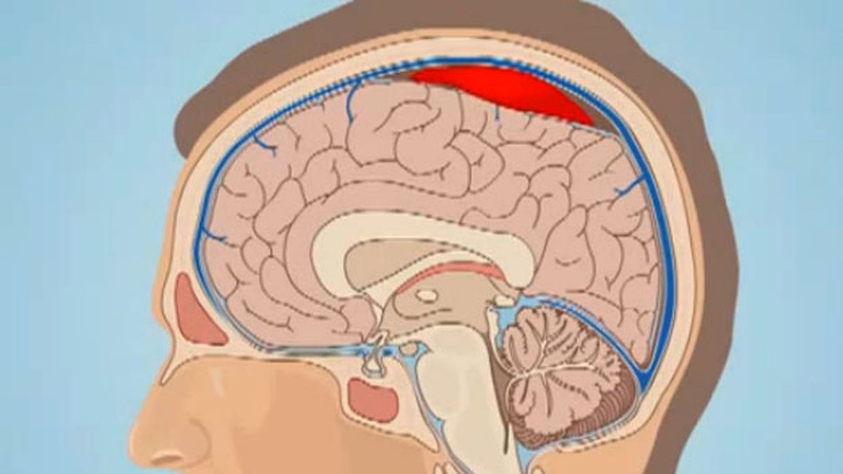 hematoma subdural que une las venas