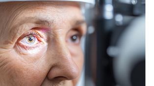 Glaucoma