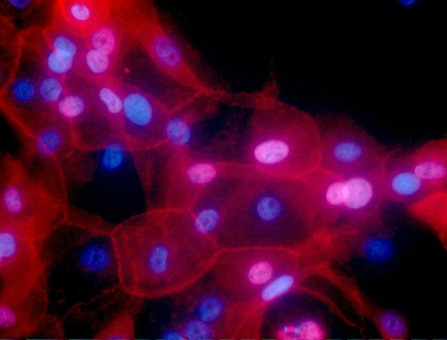 Peligro. Células de cáncer de mama en un cultivo coloreado.