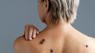Nuevo tratamiento contra el cáncer de piel, una vacuna creada en Argentina